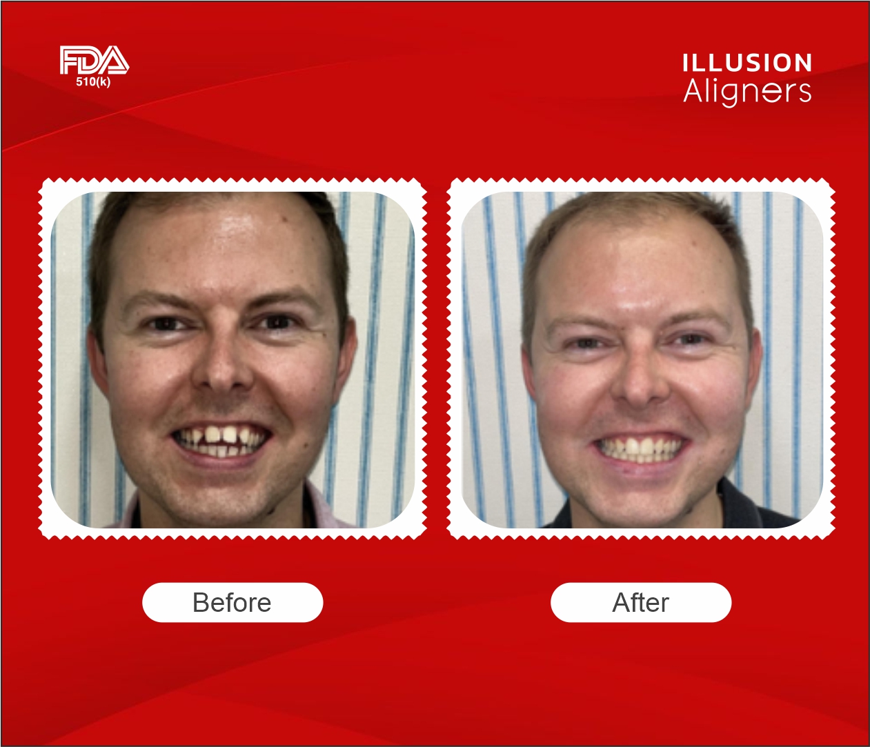 class 2 malocclusion